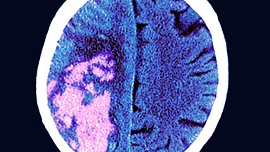 Interventional Neuroradiology