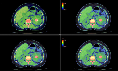 Four cross-sectional images of kidney stone calcium oxalate.