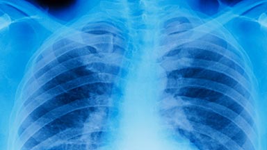 Pulmonary Hypertension