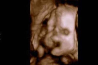 Why To Avoid Keepsake 3 D And 4 D Ultrasounds Your Pregnancy Matters Ut Southwestern Medical Center