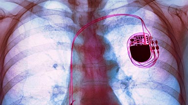 Thoracic Surgery