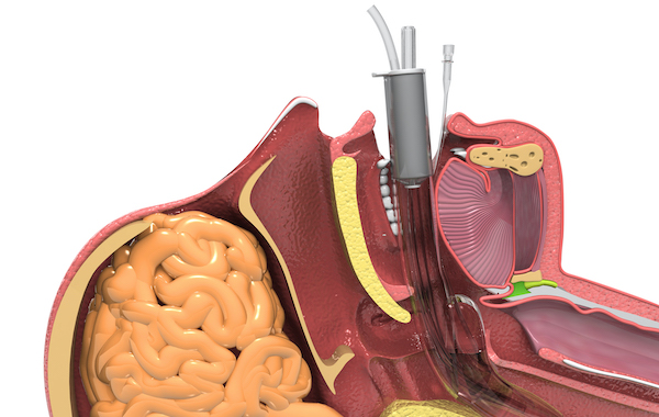 A detailed medical illustration showing a ventilator scope.