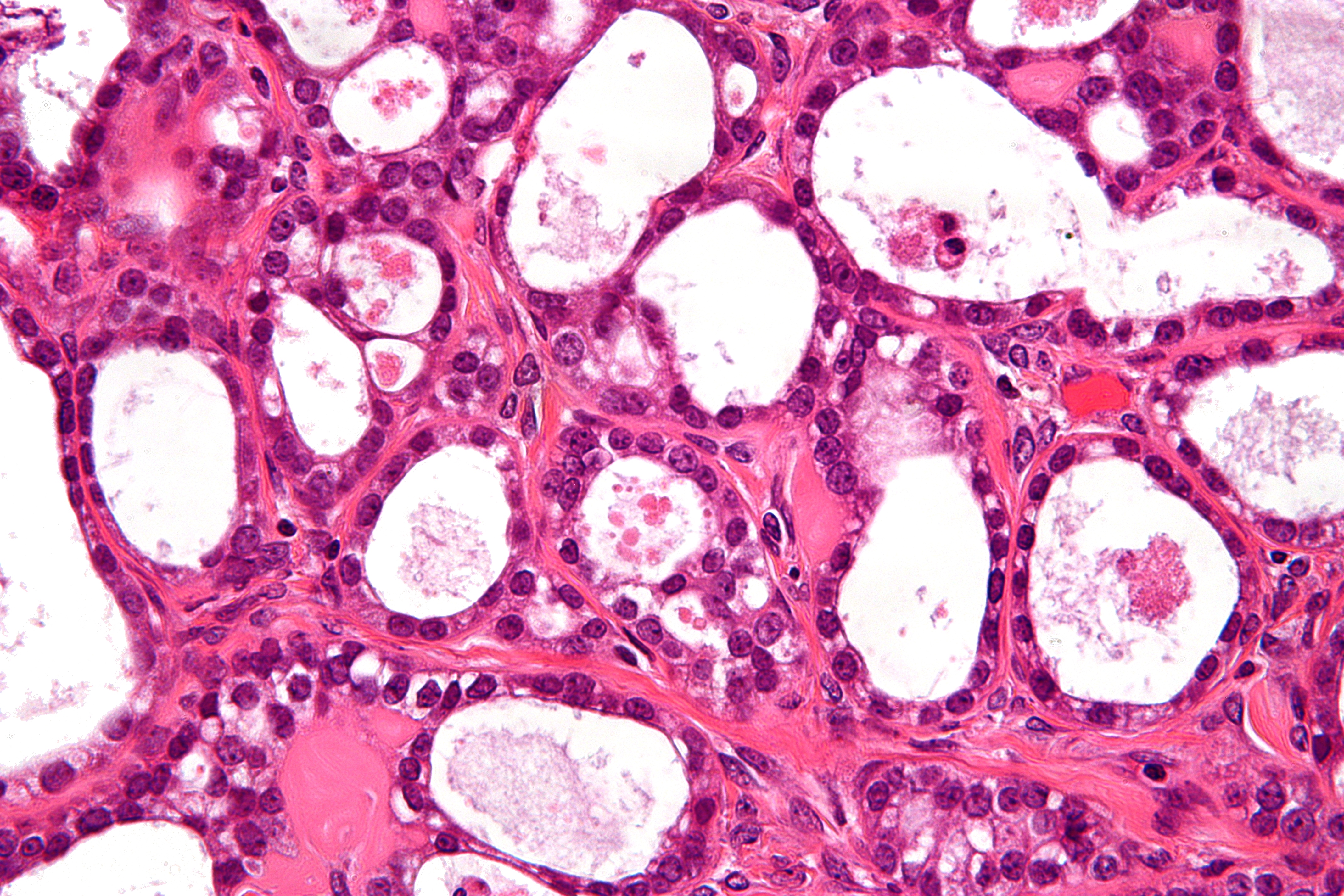 Linking Of Mutations In 12 Genes To Ovarian Cancers May Lead To More