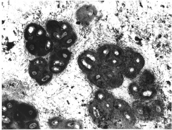 Bacterial clusters living in the lungs of a cystic fibrosis patient are highly resistant to killing by antibiotics.