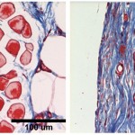 Two tissue samples showing differences in collagen build-up.