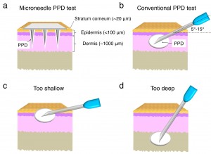 Comparing a microneedle tuberculosis test with one given with a hypodermic needle.