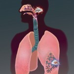 TB in lower lungs