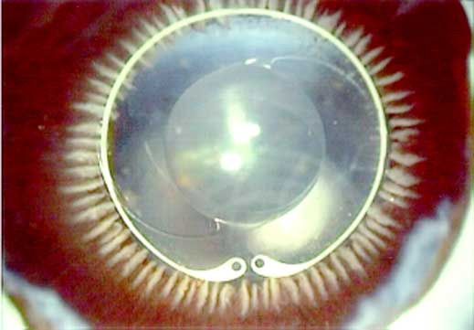 A commercially available artificial lens implanted in an eye. The UW’s device would one day be embedded into the part of the lens known as the capsular tension ring, which circles the perimeter.