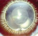 A commercially available artificial lens implanted in an eye.