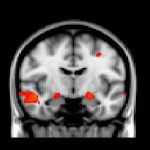 brain scan showing activation of the amygdala in the left hemisphere