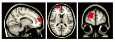 Regions of the brain where maltreated children had greater activity than non-maltreated children when trying to decrease their emotional response to negative images.