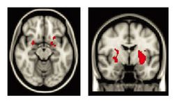 Regions of the brain where maltreated children had greater activity than non-maltreated children when looking at negative images.