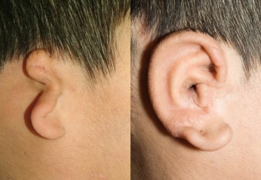 Before and after ear reconstruction photos