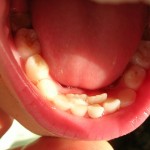 Close-up of child's teeth