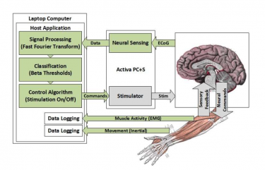 In the UW CSNE team’s experimental setup, brain signals in the motor cortex are sensed by the Activa PC+S and processed on a laptop computer. When the system detects movement in an affected limb, deep brain stimulation in the thalamus is activated to control tremor symptoms.