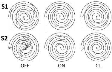 A new closed-loop deep brain stimulation system (results at right) developed by the UW-based CNSE delivers relief from symptoms of essential tremor that cause patients hands to shake (left) as successfully as current DBS methods (middle), but using far less battery life.