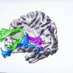 This illustration of the brain shows the arcuate fasciculus (green); inferior longitudinal fasciculus (blue) and posterior callosal connections (pink).