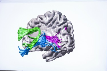 This illustration of the brain shows the arcuate fasciculus (green); inferior longitudinal fasciculus (blue) and posterior callosal connections (pink).
