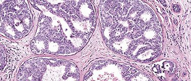 The artificial intelligence system outperformed doctors in differentiating ductal carcinoma in situ (pictured) from atypia, one of the more challenging diagnoses in breast cancer cases.Elmore Lab/UCLA